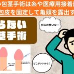 切らない包茎手術の手法や費用＆メリットデメリットなどを解説